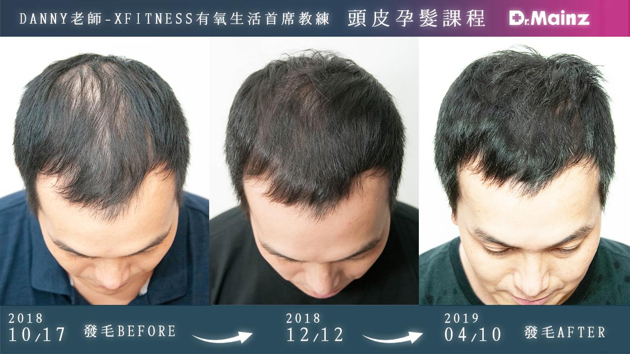 偷偷告訴你生髮的祕訣《孕髮療程》 (6)