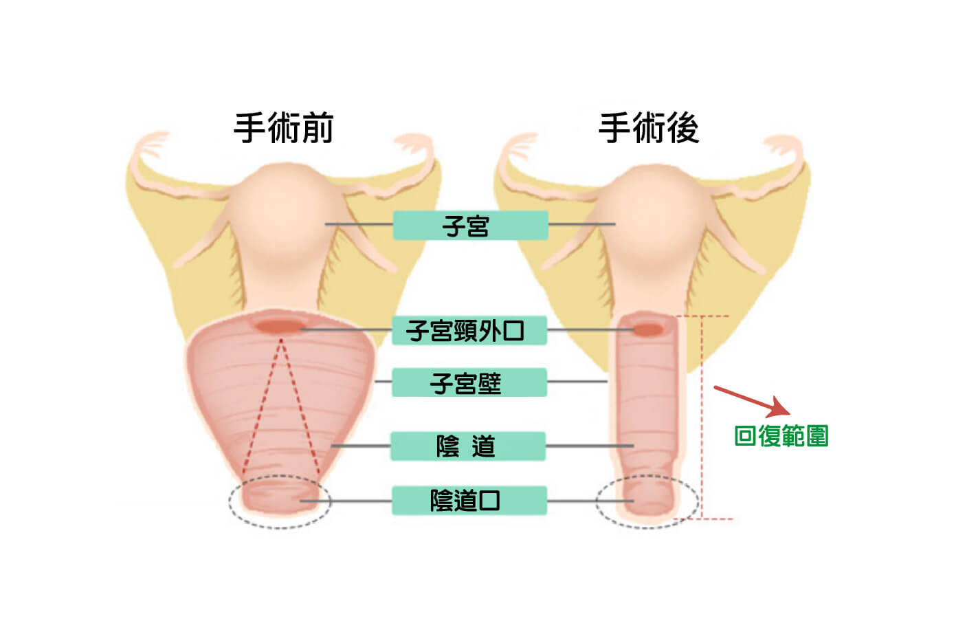 女童　小陰唇 產後私密處鬆弛、變形困擾，醫美整形找回少女緊緻感- 麥茵茲美形診所