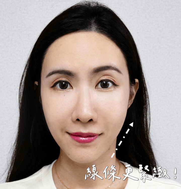 ig電波療程後效果