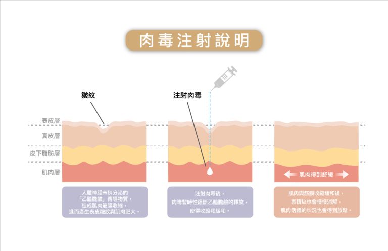 肉毒效果