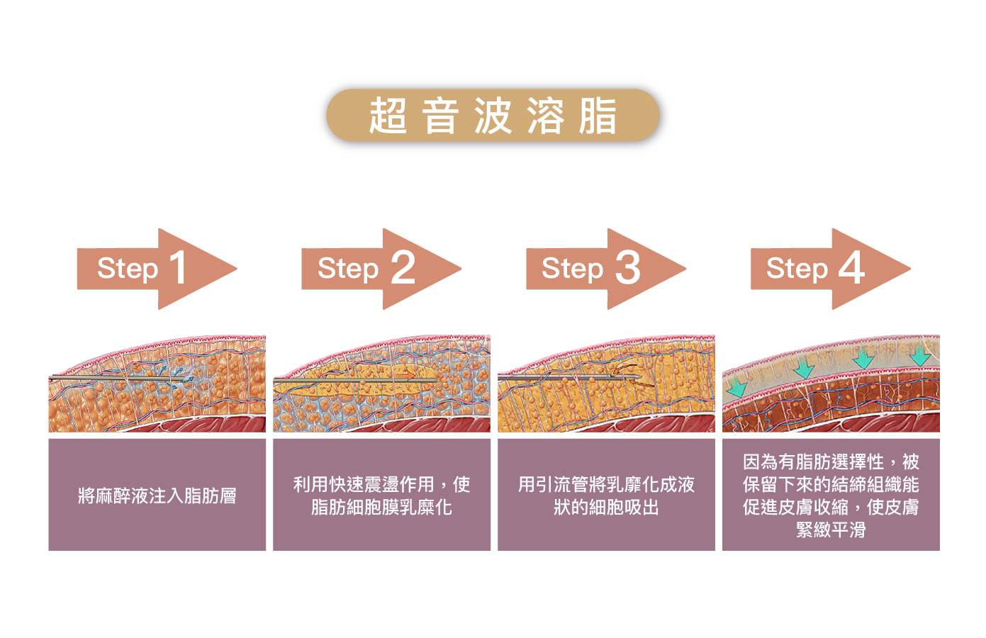 超音波溶脂方式
