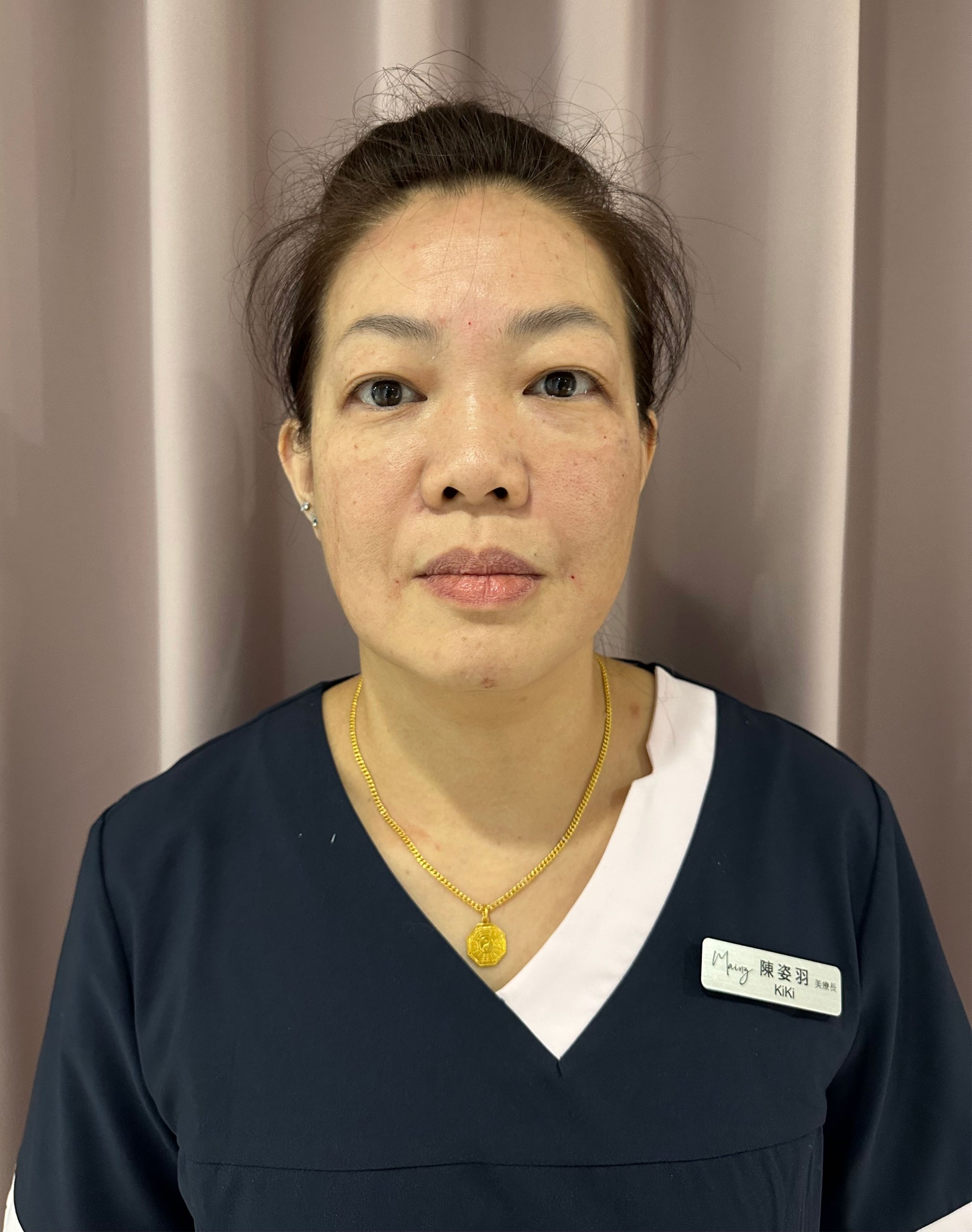 蜂巢玻尿酸-術後after