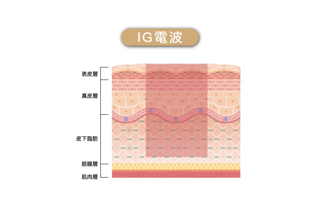ig電波改善嘴邊肉
